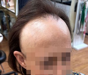 clienta con alopecia frontal fibrosante antes de la colocacion de protesis capilares